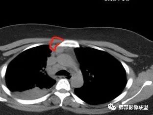 【病例】右中下肺典型类癌1例CT影像讨论