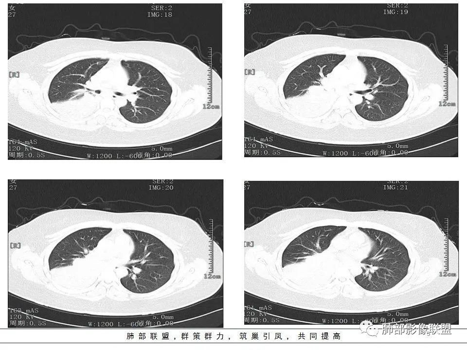 【病例】右中下肺典型类癌1例CT影像讨论