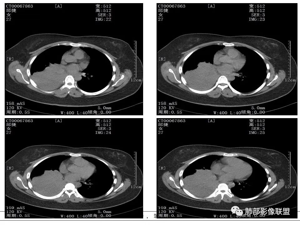 【病例】右中下肺典型类癌1例CT影像讨论