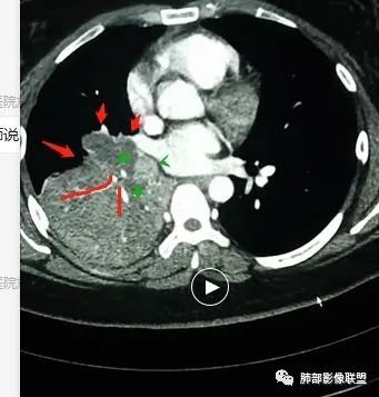 【病例】右中下肺典型类癌1例CT影像讨论
