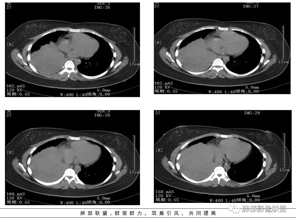 【病例】右中下肺典型类癌1例CT影像讨论