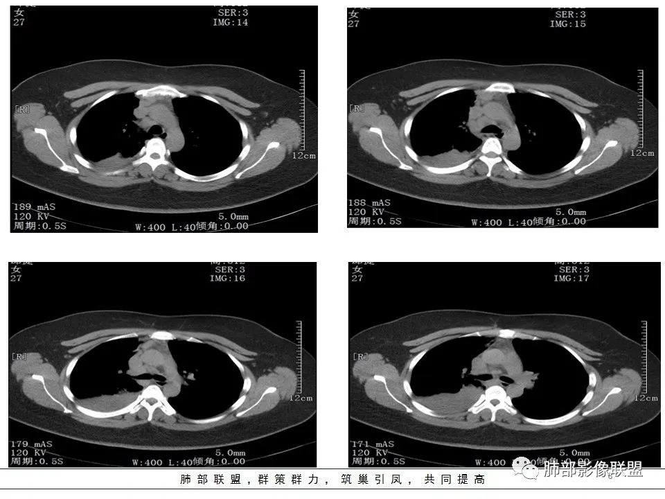 【病例】右中下肺典型类癌1例CT影像讨论