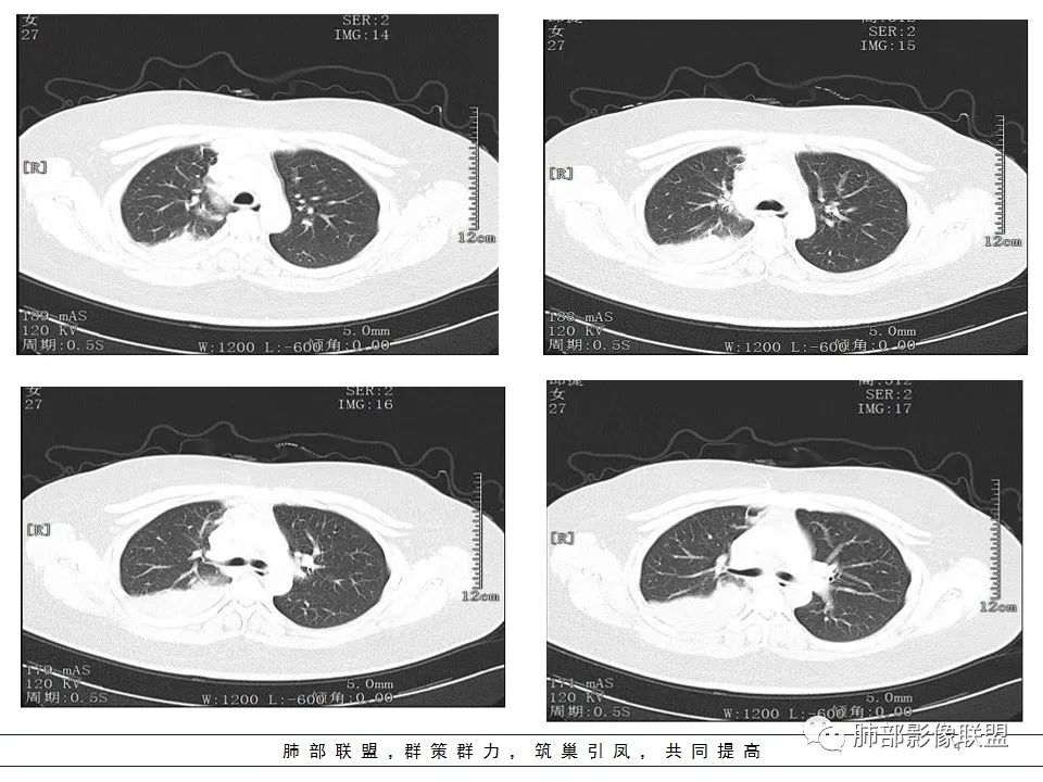 【病例】右中下肺典型类癌1例CT影像讨论