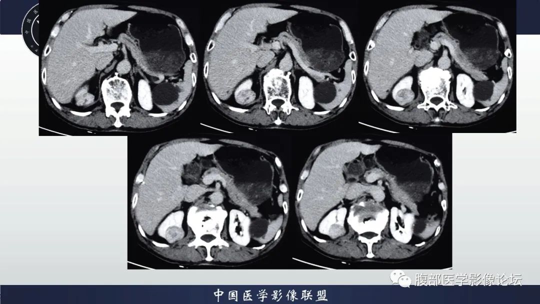 【病例】右肾嗜酸细胞腺瘤1例CT影像