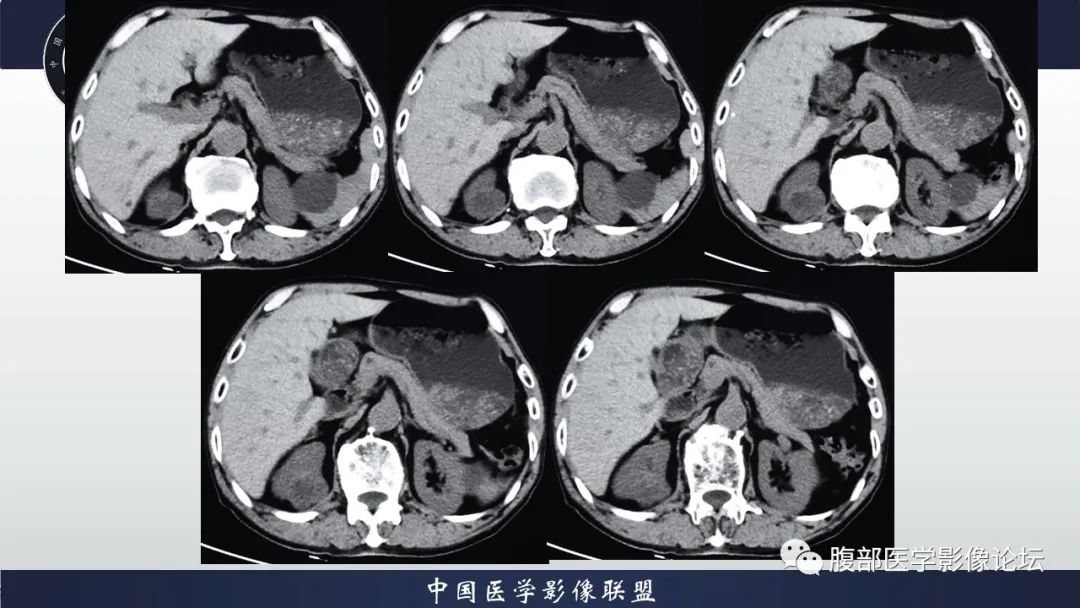 【病例】右肾嗜酸细胞腺瘤1例CT影像