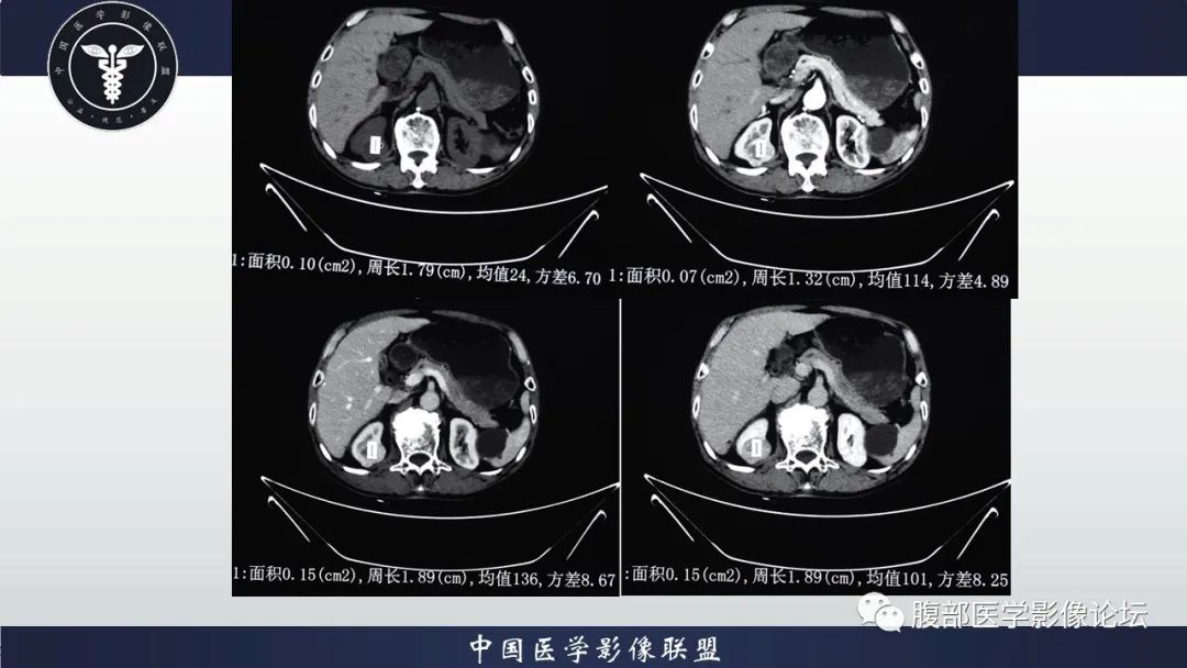 【病例】右肾嗜酸细胞腺瘤1例CT影像