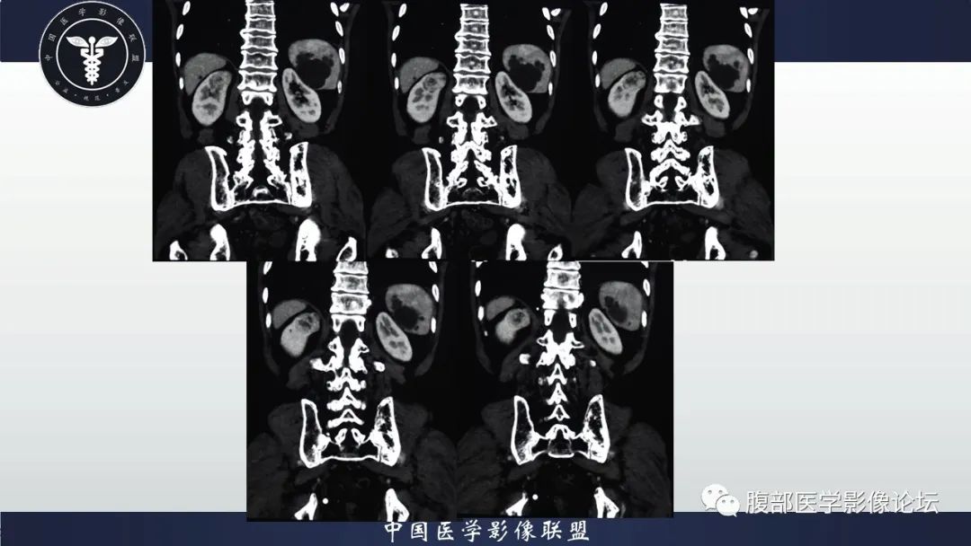 【病例】右肾嗜酸细胞腺瘤1例CT影像