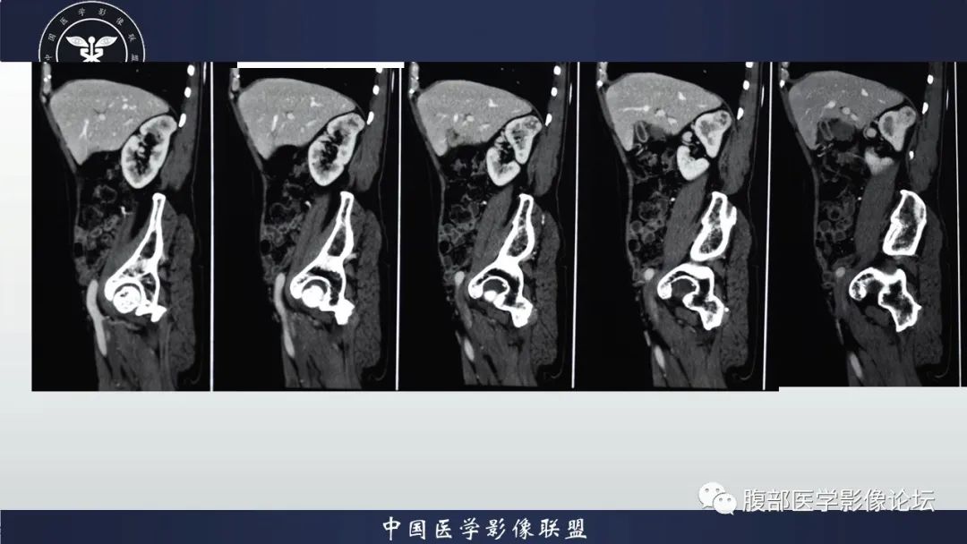 【病例】右肾嗜酸细胞腺瘤1例CT影像