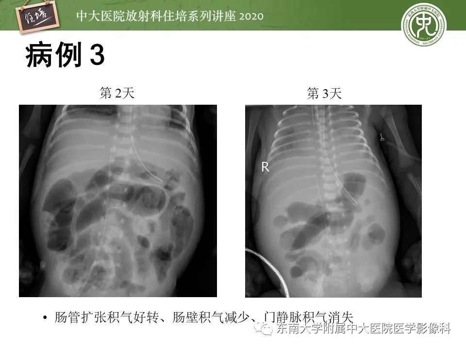 【PPT】新生儿坏死性小肠结肠炎的影像学表现