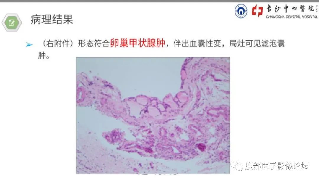 【病例】卵巢甲状腺肿1例CT影像