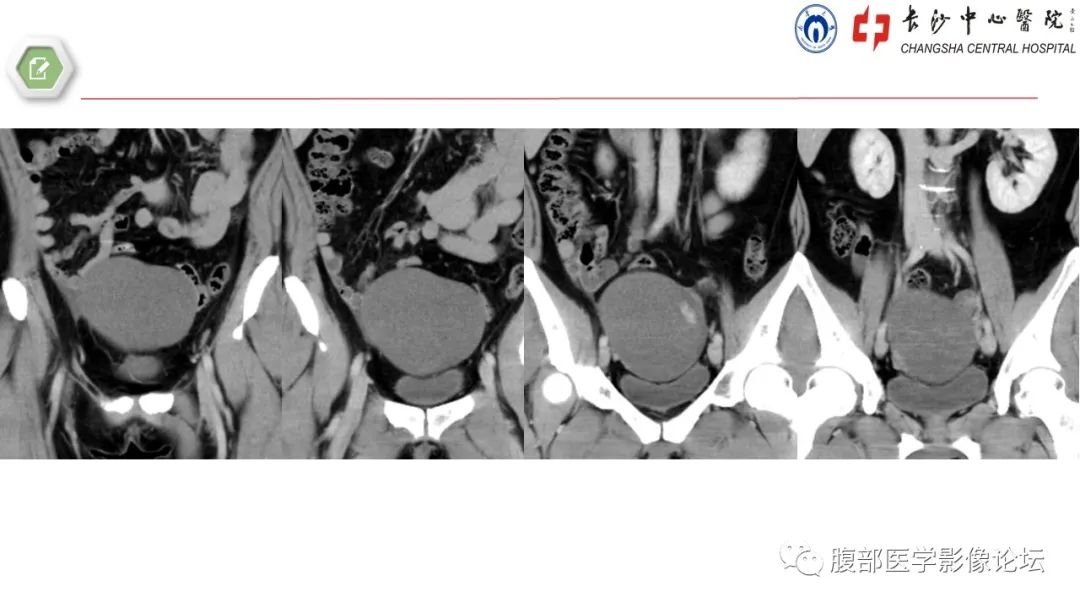 【病例】卵巢甲状腺肿1例CT影像