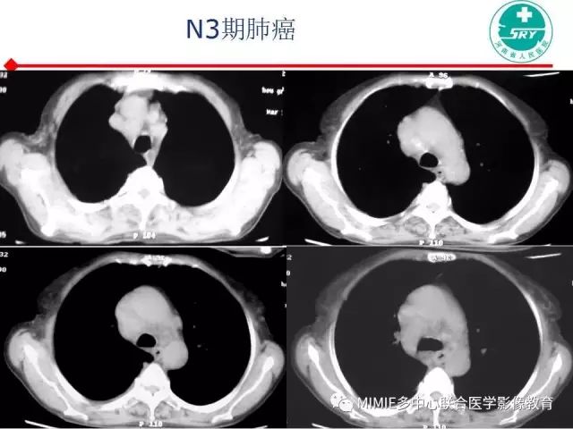 【PPT】胸部淋巴结分区及其在肺癌定性和分期诊断中的价值