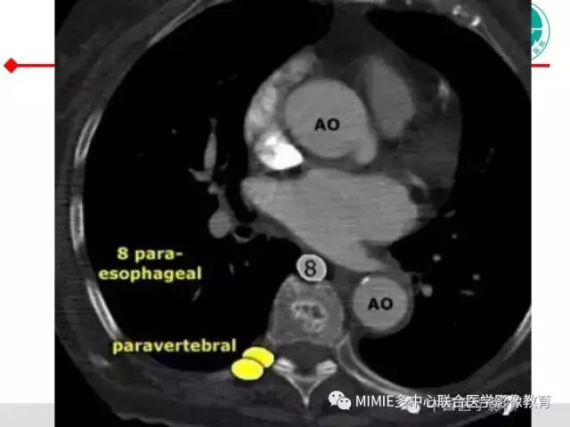 【PPT】胸部淋巴结分区及其在肺癌定性和分期诊断中的价值
