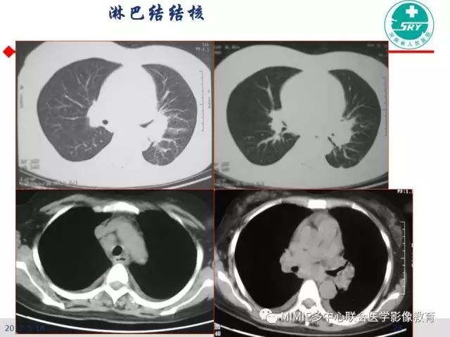 【PPT】胸部淋巴结分区及其在肺癌定性和分期诊断中的价值