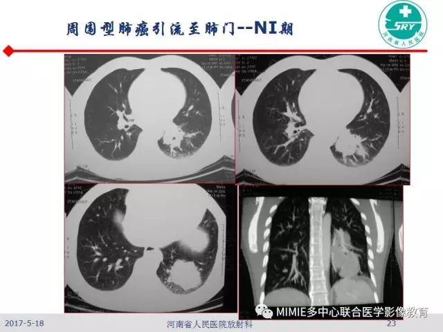 【PPT】胸部淋巴结分区及其在肺癌定性和分期诊断中的价值