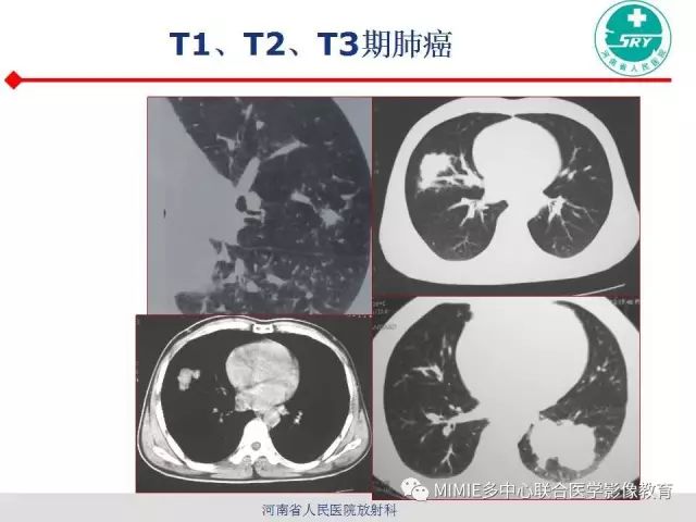 【PPT】胸部淋巴结分区及其在肺癌定性和分期诊断中的价值