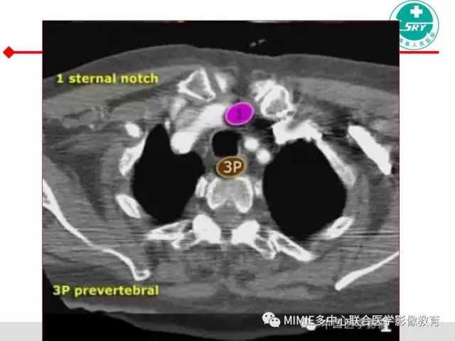 【PPT】胸部淋巴结分区及其在肺癌定性和分期诊断中的价值