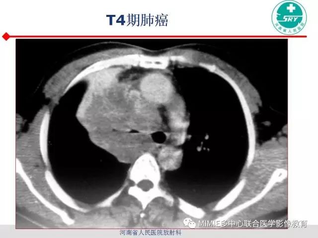 【PPT】胸部淋巴结分区及其在肺癌定性和分期诊断中的价值