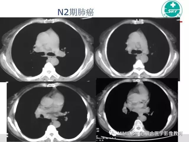 【PPT】胸部淋巴结分区及其在肺癌定性和分期诊断中的价值