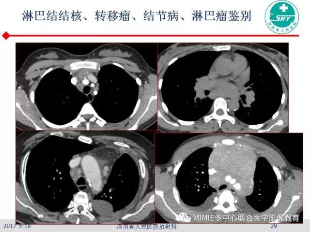 【PPT】胸部淋巴结分区及其在肺癌定性和分期诊断中的价值