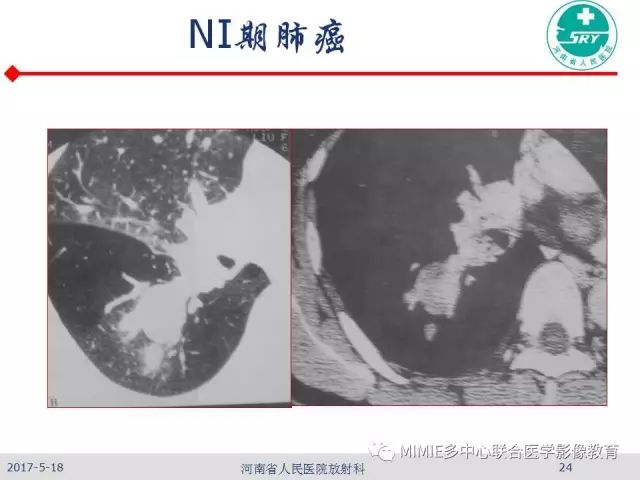 【PPT】胸部淋巴结分区及其在肺癌定性和分期诊断中的价值