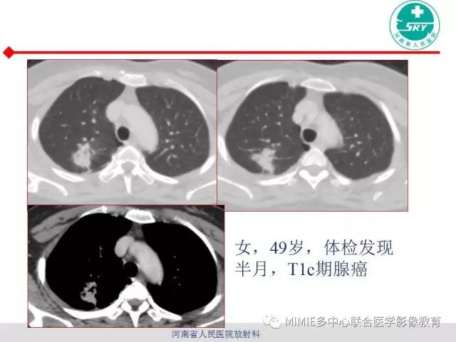 【PPT】胸部淋巴结分区及其在肺癌定性和分期诊断中的价值