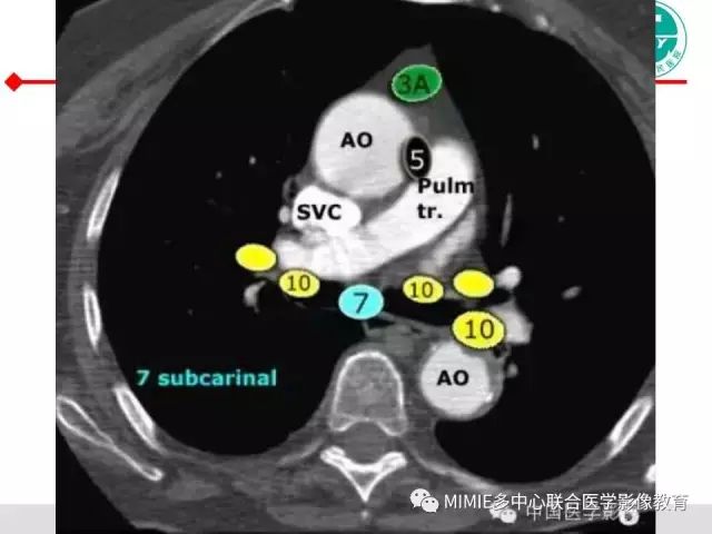 【PPT】胸部淋巴结分区及其在肺癌定性和分期诊断中的价值
