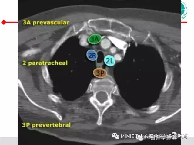 【PPT】胸部淋巴结分区及其在肺癌定性和分期诊断中的价值