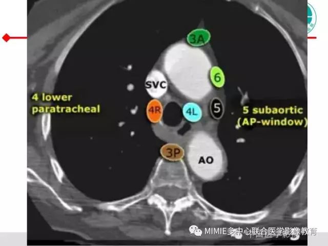 【PPT】胸部淋巴结分区及其在肺癌定性和分期诊断中的价值