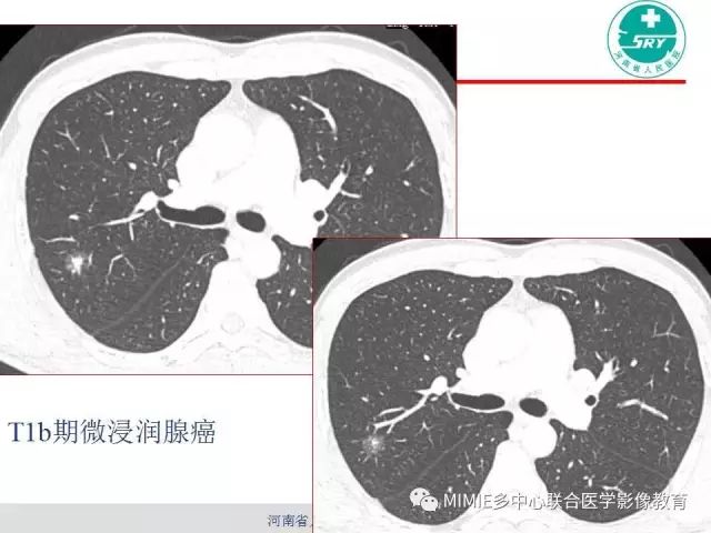 【PPT】胸部淋巴结分区及其在肺癌定性和分期诊断中的价值