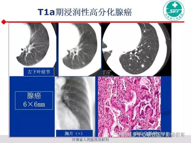 【PPT】胸部淋巴结分区及其在肺癌定性和分期诊断中的价值