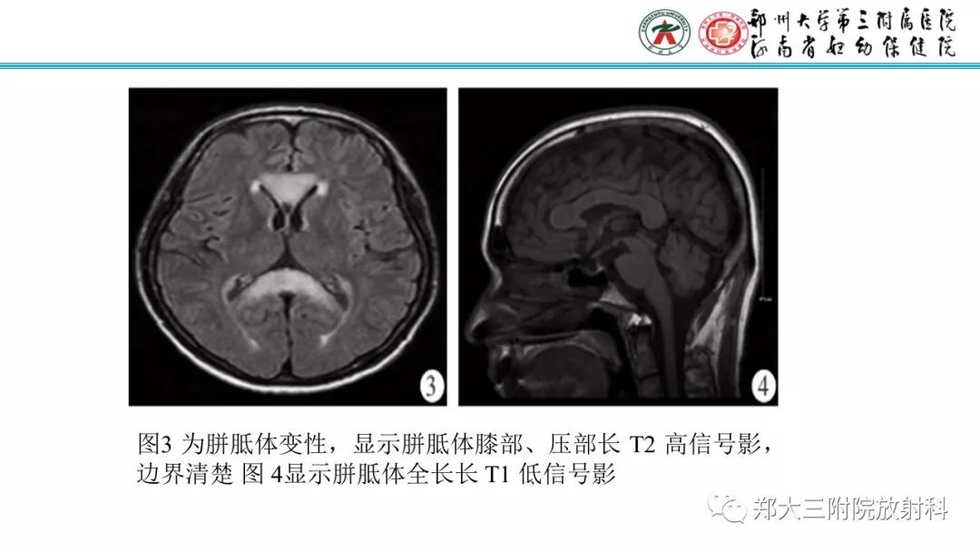 【PPT】中毒性脑病影像诊断