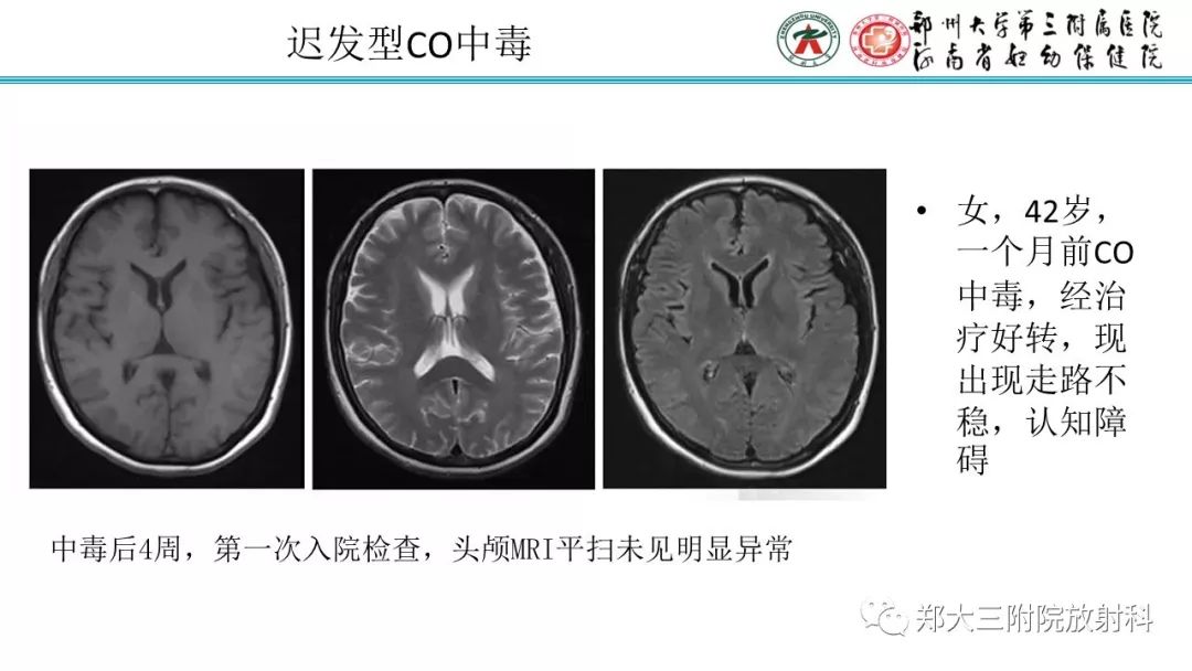 【PPT】中毒性脑病影像诊断