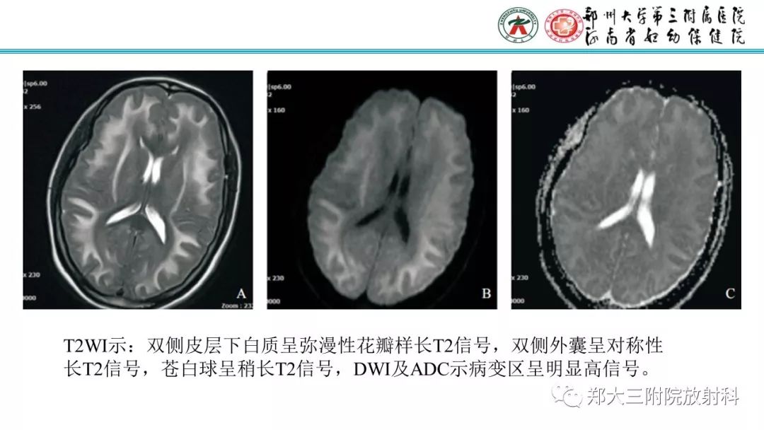 【PPT】中毒性脑病影像诊断