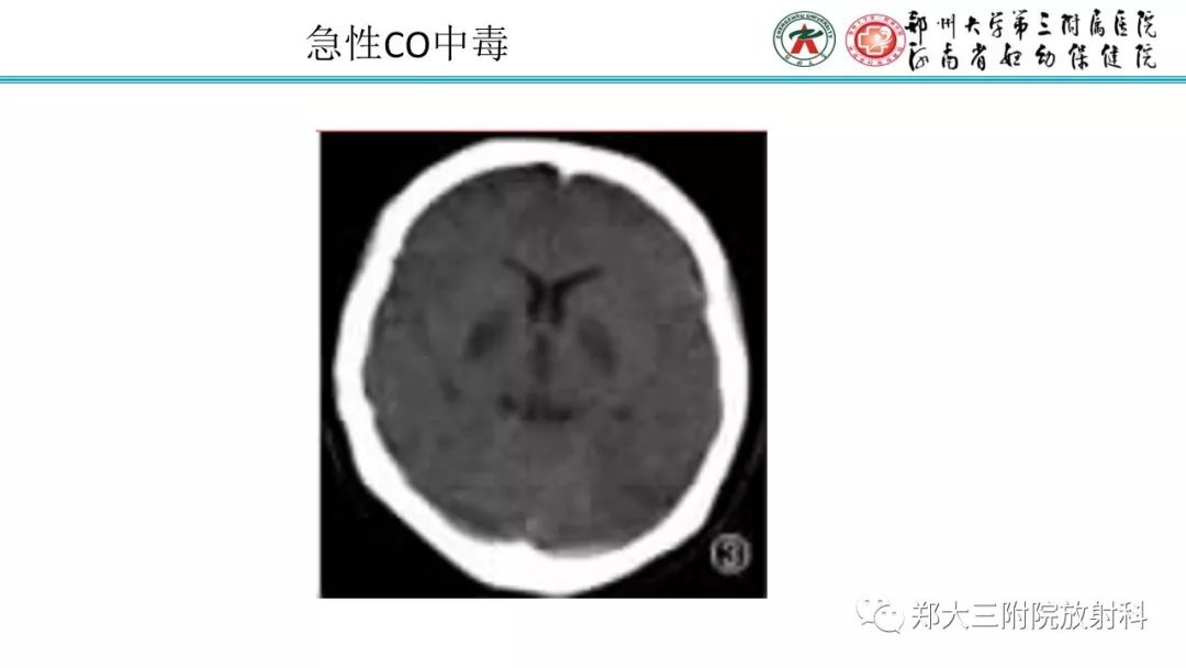 【PPT】中毒性脑病影像诊断