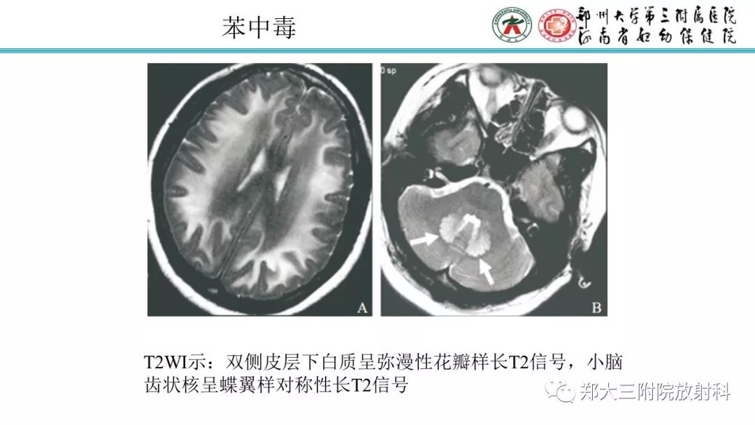 【PPT】中毒性脑病影像诊断
