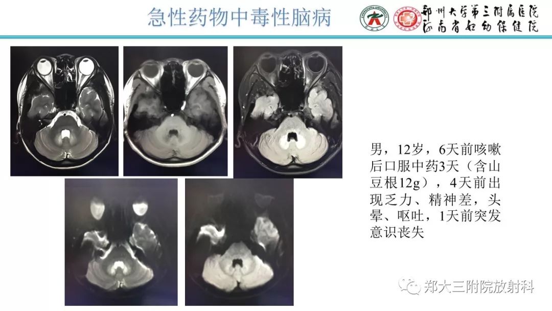 【PPT】中毒性脑病影像诊断