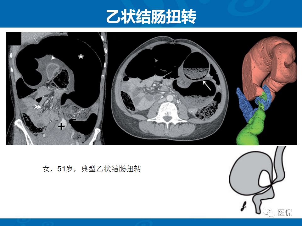 【PPT】结肠扭转CT诊断