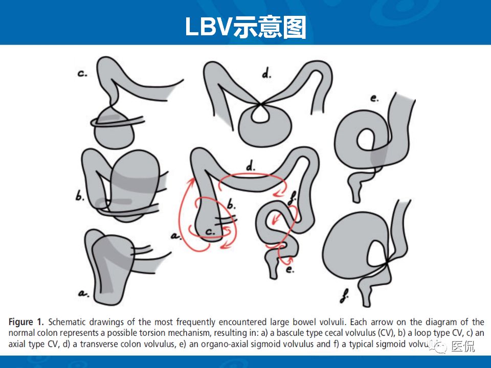 【PPT】结肠扭转CT诊断