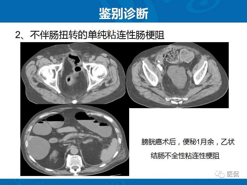 【PPT】结肠扭转CT诊断