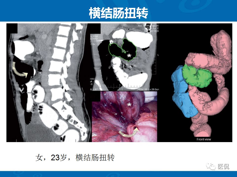 【PPT】结肠扭转CT诊断