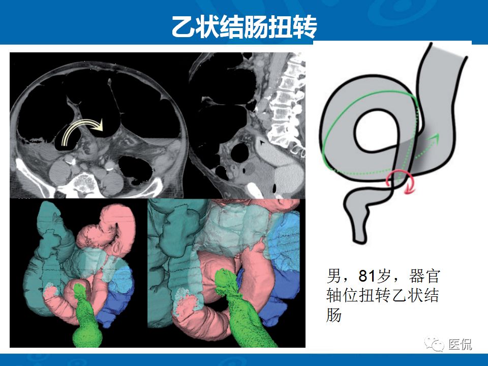 【PPT】结肠扭转CT诊断