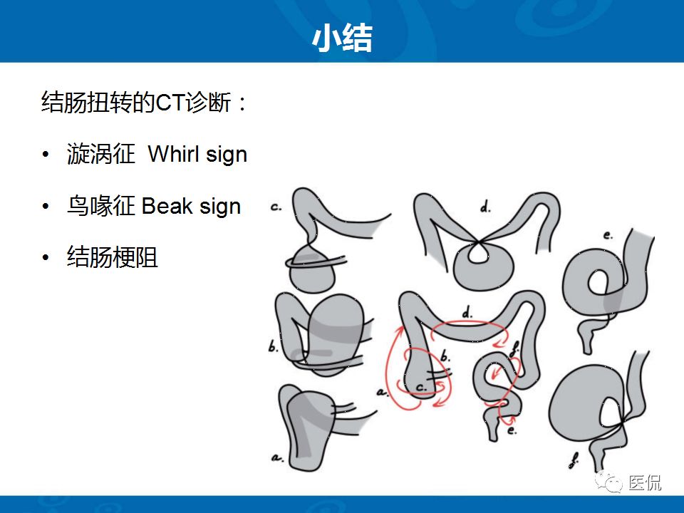 【PPT】结肠扭转CT诊断