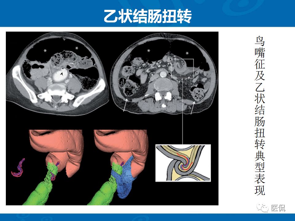 【PPT】结肠扭转CT诊断