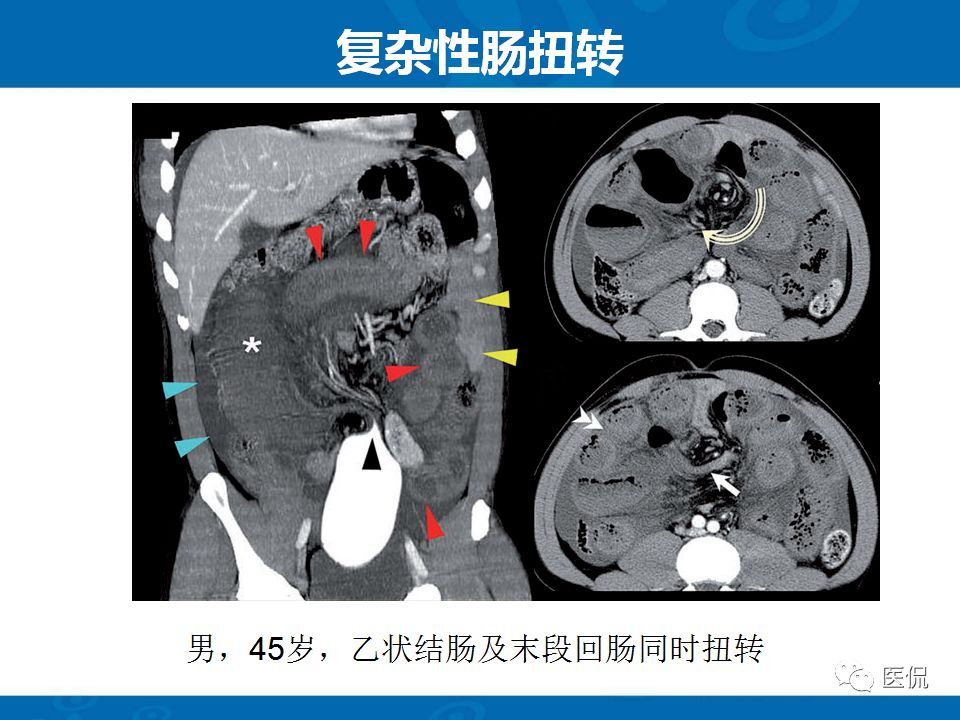 【PPT】结肠扭转CT诊断