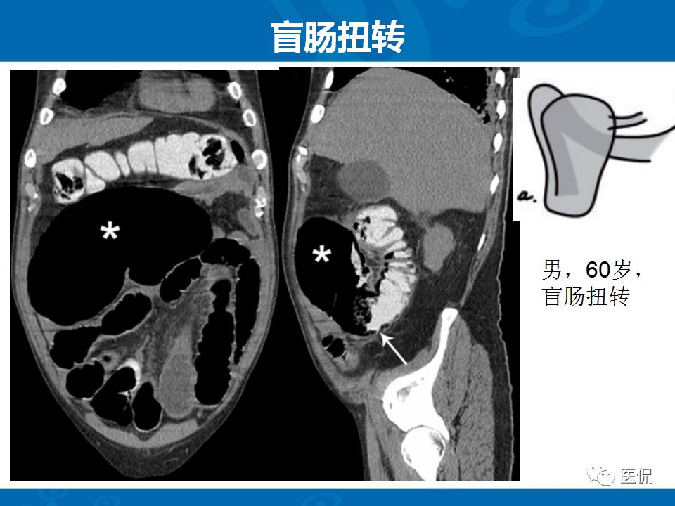 【PPT】结肠扭转CT诊断