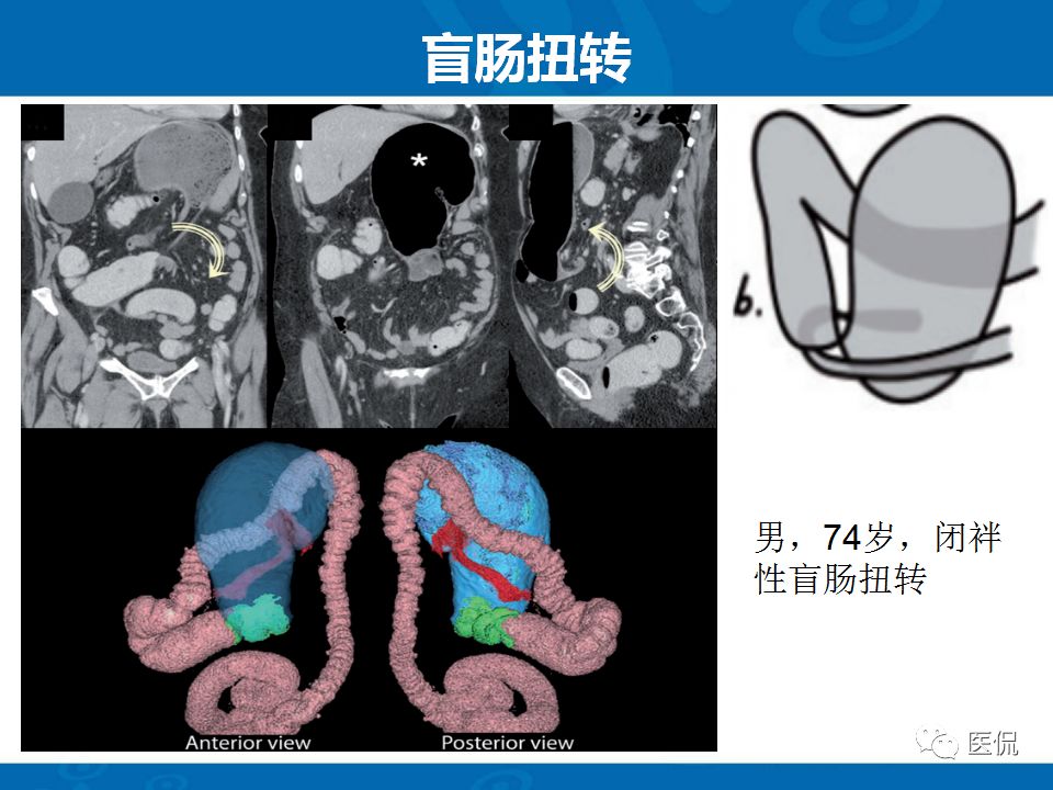 【PPT】结肠扭转CT诊断