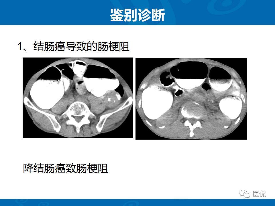 【PPT】结肠扭转CT诊断