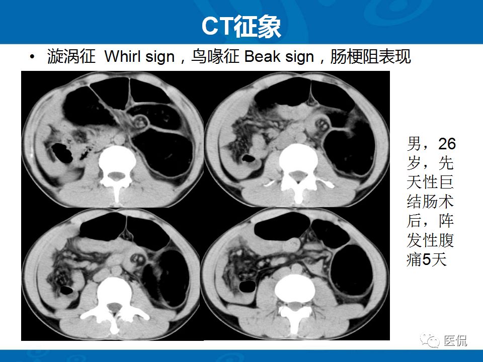 【PPT】结肠扭转CT诊断