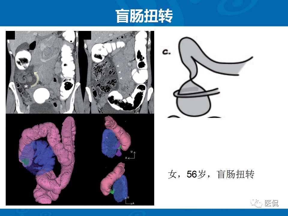 【PPT】结肠扭转CT诊断